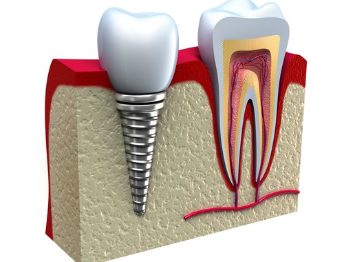 Implantes dentales en Xàtiva: la mejor solución para recuperar tu sonrisa